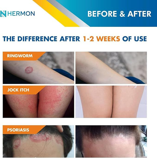 Hermon Powerful Antifungal Ringworm Cream - Effective Treatment for Stubborn Ringworm, Jock Itch, Eczema, Tinea Versicolor, Athlete's Foot - for Adults and Kids - 100ml (2 Pack)