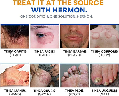 Hermon Ringworm Treatment Anti-fungal Kit - RingWorm Treatment for Humans 3.52 oz cream 4 oz soap bar for Ringworm, Athlete's Foot, Jock Itch, Eczema, Tinea - for Adults and Kids