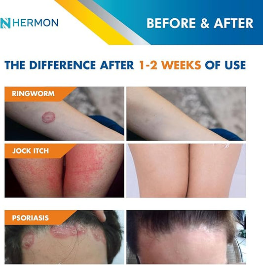Hermon Powerful Antifungal Ringworm Cream - Effective Treatment for Stubborn Ringworm, Jock Itch, Eczema, Tinea Versicolor, Athlete's Foot - for Adults and Kids - 100ml
