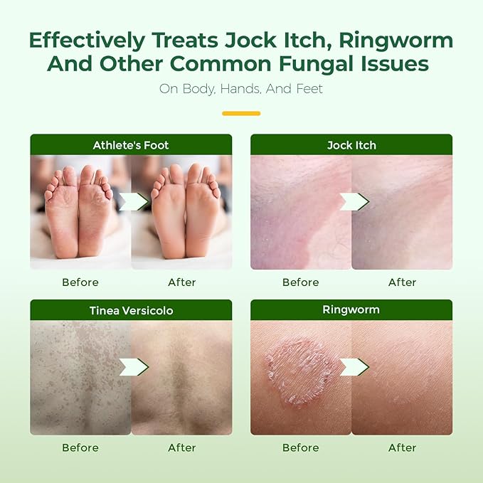 Inlifay Antifungal Soap with Tea Tree Oil: Antifungal Bar Soothing Care & Fast Itch Relief for Ringworm Jock Itch Tinea Versicolor Athlete's Foot - Home Travel Gym Use for Active Men