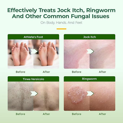 Inlifay Antifungal Soap with Tea Tree Oil: Antifungal Bar Soothing Care & Fast Itch Relief for Ringworm Jock Itch Tinea Versicolor Athlete's Foot - Home Travel Gym Use for Active Men