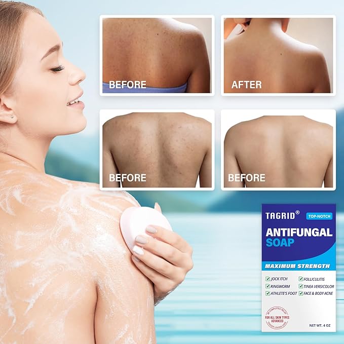 TAGRID Antifungal Soap Treatment for Body: Antibacterial Tea Tree Soap Suitable for Athletes' Post-workout rinse - Treatment for Jock Itch, Ringworm, Folliculitis, Tinea Versicolor, and Fungal Acne.