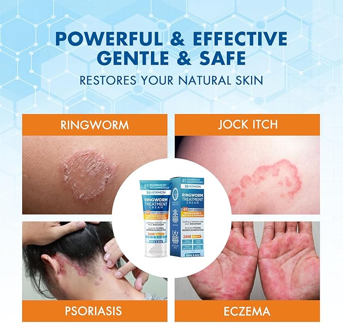 Hermon Powerful Antifungal Ringworm Cream - Effective Treatment for Stubborn Ringworm, Jock Itch, Eczema, Tinea Versicolor, Athlete's Foot - for Adults and Kids - 100ml