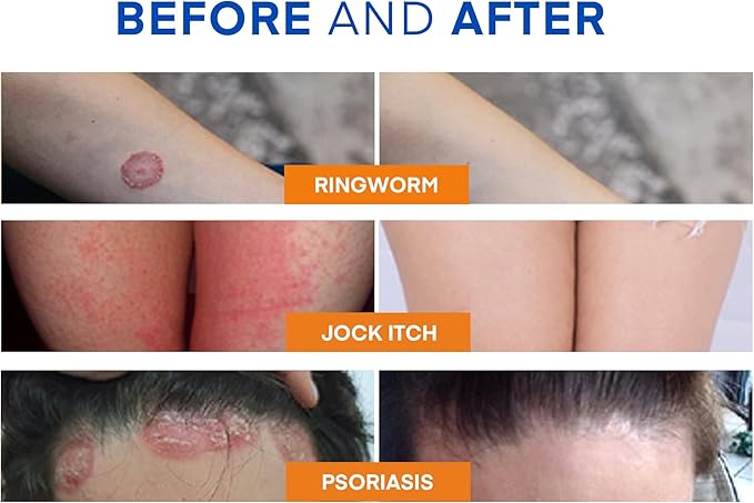 Hermon Powerful Ringworm Antifungal Soap – Treatment for Ringworm, Athlete’s Foot & Jock Itch – Tea Tree Oil & Sulfur Formula – Fungal Soap for Daily Body Wash – 2 Pack
