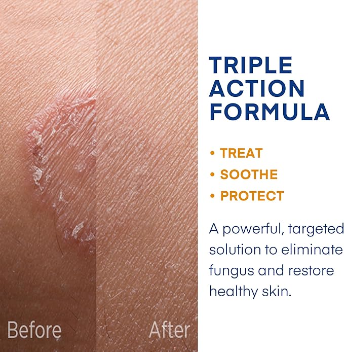 Hermon Powerful Antifungal Ringworm Cream - Effective Treatment for Stubborn Ringworm, Jock Itch, Eczema, Tinea Versicolor, Athlete's Foot - for Adults and Kids - 100ml