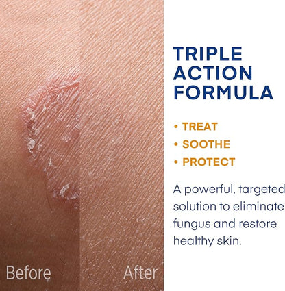 Hermon Powerful Antifungal Ringworm Cream - Effective Treatment for Stubborn Ringworm, Jock Itch, Eczema, Tinea Versicolor, Athlete's Foot - for Adults and Kids - 100ml